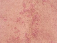 Generalized eruptive histiocytoma