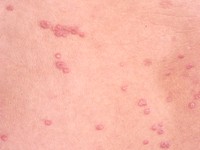 Generalized eruptive histiocytoma