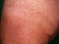 Toxicodermie: maculopapuleus exantheem