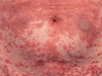 Toxicodermie: maculopapuleus exantheem