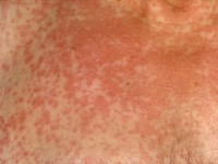 Toxicodermie: maculopapuleus exantheem