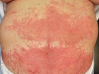 Toxicodermie: maculopapuleus exantheem