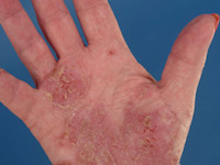 Geneesmiddelenreactie certolizumab-pegol