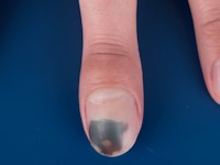 Giant cell tumor of bone