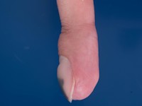 Giant cell tumor of bone