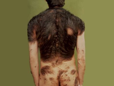 Giant congenital melanocytic nevus