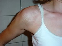 Glad spiercel hamartoom