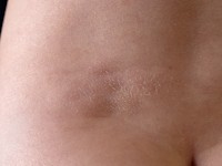 Glad spiercel hamartoom