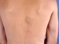 Glad spiercel hamartoom