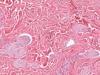 Glad spiercel hamartoom