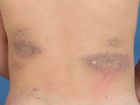 Glomuveneuze malformatie