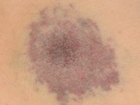 Glomuveneuze malformatie