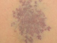 Glomuveneuze malformatie