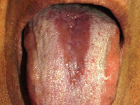 Glossitis mediana rhomboidalis