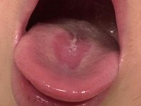 Glossitis mediana rhomboidalis