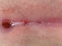 Gluteal pits bij sinus pilonidalis