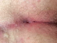 Gluteal pits bij sinus pilonidalis