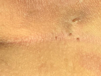 Gluteal pits bij sinus pilonidalis