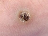 Differentiele diagnose van het granuloma pyogenicum: Kaposi sarcoom