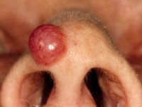 Differentiele diagnose van het granuloma pyogenicum: Merkelcel tumor