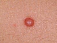 Differentiele diagnose van het granuloma pyogenicum: Spitz naevus