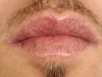 Graft versus host disease