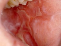 Graft versus host disease