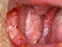 Graft versus host disease