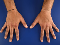 Gottron-like plaques bij graft versus host disease