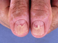 Gottron-like plaques bij graft versus host disease