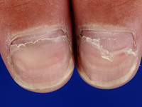 Gottron-like plaques bij graft versus host disease