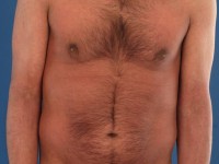 Graft versus host disease