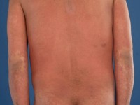 Graft versus host disease