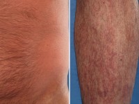 Graft versus host disease