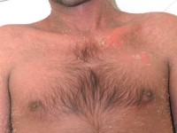 Graft versus host disease