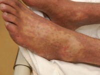 Graft versus host disease