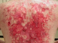 Graft versus host disease