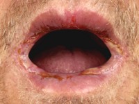 Graft versus host disease