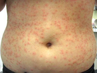 Hot tub folliculitis