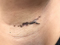 Granular parakeratosis