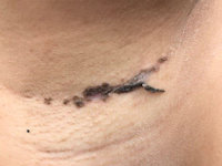 Granular parakeratosis