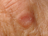 granuloma annulare