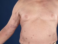 Granuloma annulare disseminata