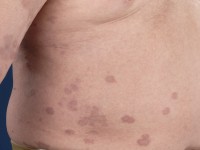 Granuloma annulare disseminata