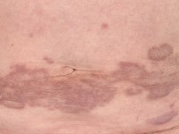 Granuloma annulare disseminata