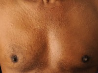 Granuloma annulare disseminata