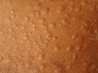 Granuloma annulare disseminata