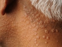 Granuloma annulare disseminata