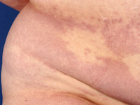 Granuloma annulare disseminata