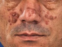 Granuloma faciale